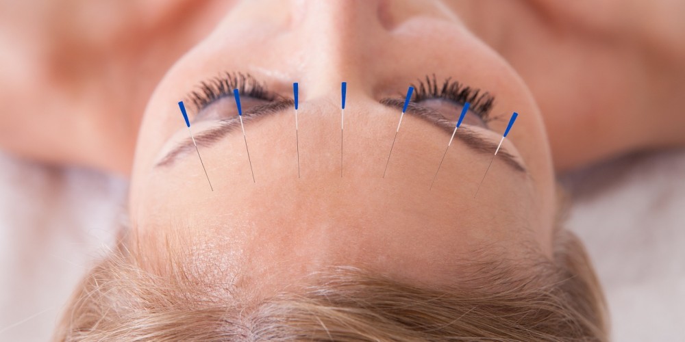 Woman Receiving An Acupuncture Needle Therapy